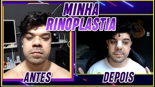 OLHA COMO MEU NARIZ ficou DEPOIS da RINOPLASTIA NARIZ MASCULINO NEGROIDE [upl. by Lexine441]