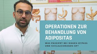 Operationen zur Behandlung von Adipositas Was passiert bei MagenBypass und SchlauchmagenOP [upl. by Adrahc]