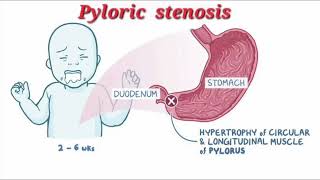 Pyloric stenosis mrcpch Video station [upl. by Atirat]