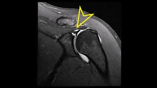 Shoulder MRI Labral SLAP Superior Labrum Anterior Posterior Tear [upl. by Refotsirk]