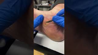 Learn how a Podiatrist expertly removes Medial Foot Callus Removal  Corn and Callus Treatment [upl. by Maril18]