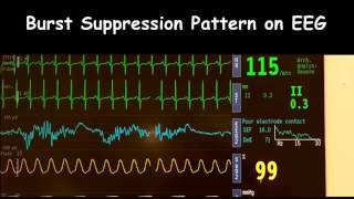 Burst Suppression Pattern Video [upl. by Nalyr]