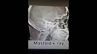 mastoid x ray ear x ray radiology shortvideo [upl. by Netsirc]