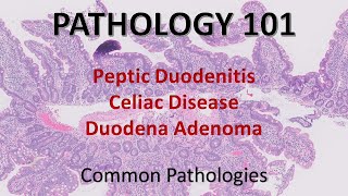 Peptic Duodenitis Celiac Disease Duodenal Adenoma  Pathology 101 GI Pathology [upl. by Yoccm325]