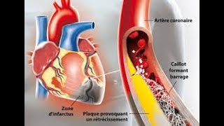 Ischémie infarctus et choc [upl. by Ahsats172]