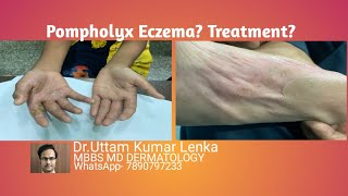 What is pompholyx eczema reason and Treatment of itchy vesiclesblisters on palms and soles [upl. by Ladonna]