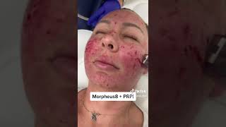 Come with me to do a Morpheus and PRP treatment [upl. by Anirbac21]