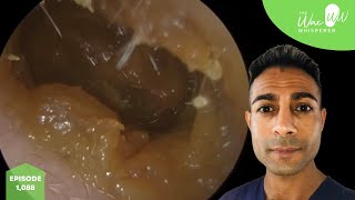 1088  10 Years Worth of Ear Wax Removal [upl. by Rebe]