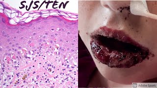 StevensJohnson SyndromeToxic Epidermal Necrolysis SJSTEN Spectrum [upl. by Sacram143]