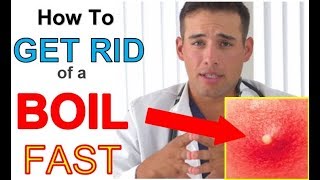 How to get RID of a Boil FAST at Home 3 STEPS  Quickest Way to GET RID of a BOIL [upl. by Einahc]