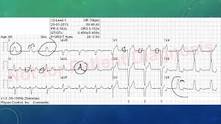 EKG befunden leicht gemacht EKG Beispiele [upl. by Gomer808]