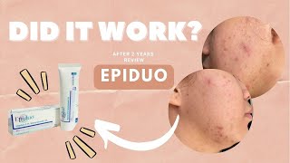 UPDATE AFTER 2 YEARS OF USING EPIDUO Philippines  Andy Buela [upl. by Iznil]