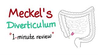 Meckels Diverticulum 1minute review [upl. by Adev]