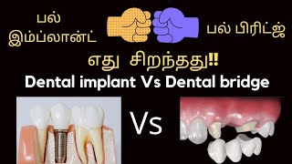 Dental implant Vs Dental bridge in tamil  பல் பதிய சிகிச்சை Vs பல் பிரிட்ஜ் [upl. by Camp]