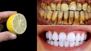 How To Make Your Teeth White In 5 Minutes 🦷😬😁 [upl. by Riane]