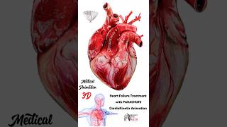 Heart Failure Treatment with PARACHUTE® CardioKinetix Animation medical animation 3d short [upl. by Pattison]