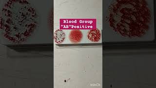 AB Positive blood group kaisa hota hai  AB positive blood group Ab position blood group test [upl. by Nuahsar]