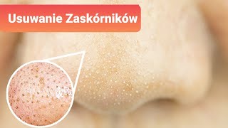 5 naturalnych sposobów na usunięcie zaskórników [upl. by Annij]