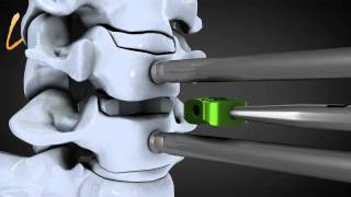 Hernie discale cervicale  Spinal disk herniation  Kisco International [upl. by Cheria]