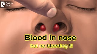 What to do for blood in my nose but there is no bleeding  DrHarihara Murthy [upl. by Aihsemek]