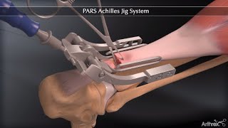 PARS Achilles Jig System [upl. by Nnagrom143]