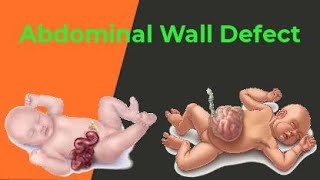 Abdominal Wall Defect with Animation by Ashish Kumar Nursingvideo [upl. by Felicio81]