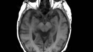 Hepatic Encephalopathy [upl. by Prowel216]