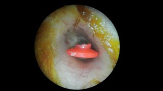 Foreign body removal from the ear canal [upl. by Adev154]