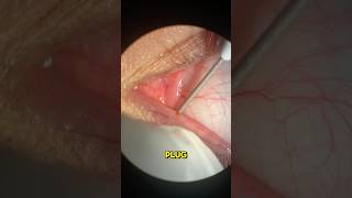 Implants for Dry Eyes [upl. by Svend69]