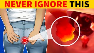 8 Critical Colon Cancer Symptoms You Should Never Ignore 15 Million Views [upl. by Arrad]