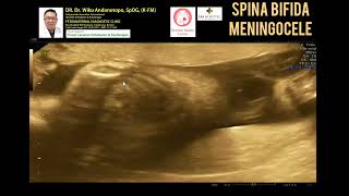 Spina Bifida Meningocele [upl. by Hoebart]