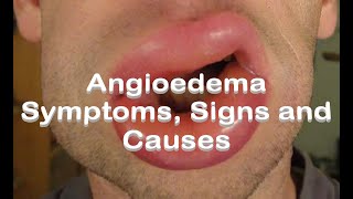 Angioedema  Symptoms Signs and Causes [upl. by Wrennie63]