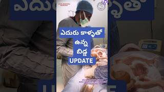 Breech delivery drkranthigynecologist ఎదురు కాళ్ళ తో ఉన్న బిడ్డ [upl. by Yehudi]