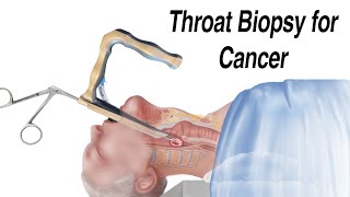 How a Throat Biopsy is Performed to Check for Throat Cancer [upl. by Natan148]