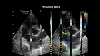 Pulmonic stenosis in a dog [upl. by Cammie]