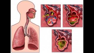 BRONQUITIS CAUSAS SÍNTOMAS Y TRATAMIENTO BRONQUIOLITIS TRATAMIENTO PARA BRONQUITIS NEBULIZACIÓN [upl. by Eelahc]