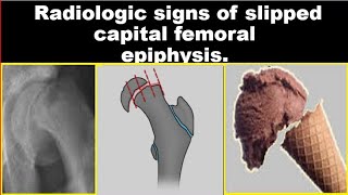 Radiologic signs of Slipped Capital Femoral Epiphysis [upl. by Nerehs]