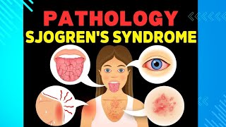 24 Sjogren Syndrome and Scleroderma [upl. by Dnomyad]