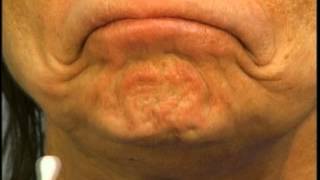 Instructions for Using Botox in the Chin by Dr Elliott of Skinspirations [upl. by Meurer]