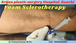 Varicose veins treatment with foam Sclerotherapy Varicose veins treatment for SSC GD medical test [upl. by Evatsug594]