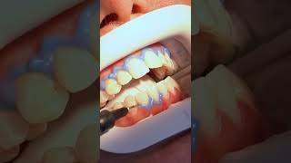 POV whitening my teeth shorts dentist toothwhitening whitenteeth spedup [upl. by Rehctelf]