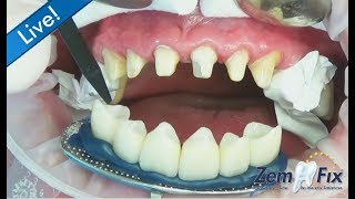 ZemFix®  inserting 6 allceramic zirconia crowns in the upper front [upl. by Nitsu]