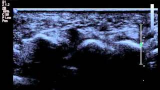 ultrasound of foot bursawmv [upl. by Elvie298]