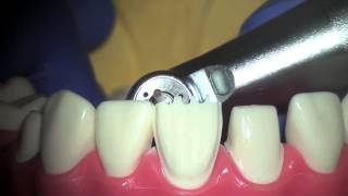 Veneer prep [upl. by Isaiah]