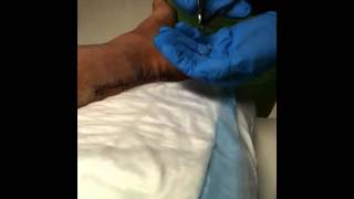 Achilles tendon staple removal [upl. by Sivart]