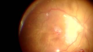 Autologous retinal transplant [upl. by Cordula]