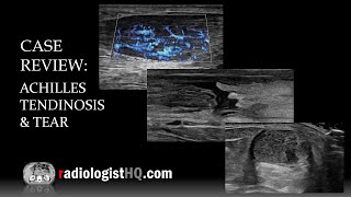 Case Review Ultrasound of Achilles Tendinosis and Tear [upl. by Lekcar769]