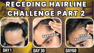 30 days HAIRLINE REGROWTH challenge PART 2  सिर्फ 1 महीने मैं RECEDING HAIRLINE REGROW करो [upl. by Asaert38]