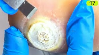 17This plantar wart is round and large [upl. by Revert]