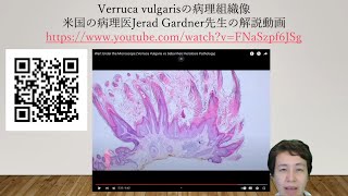 verruca vulgarisの病理組織解説 [upl. by Wendy]